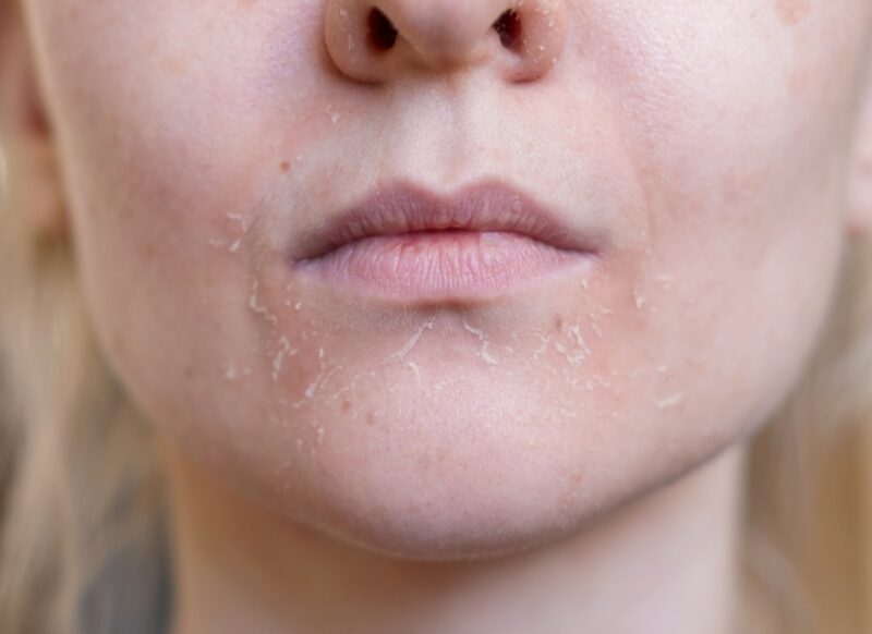 prikaz perutanja kože lica kod žene